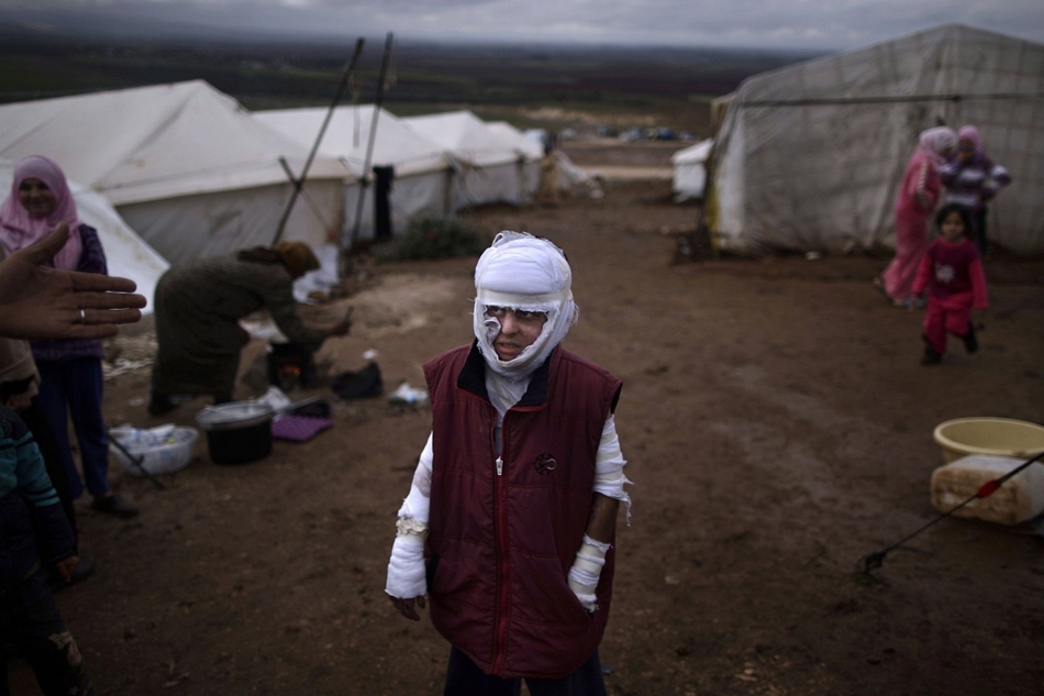 A szíriai hadsereg légicsapásai során égési sérüléseket szenvedett, 10 éves Abdullah Ahmed egy menekülttáborban Atmeh faluban.